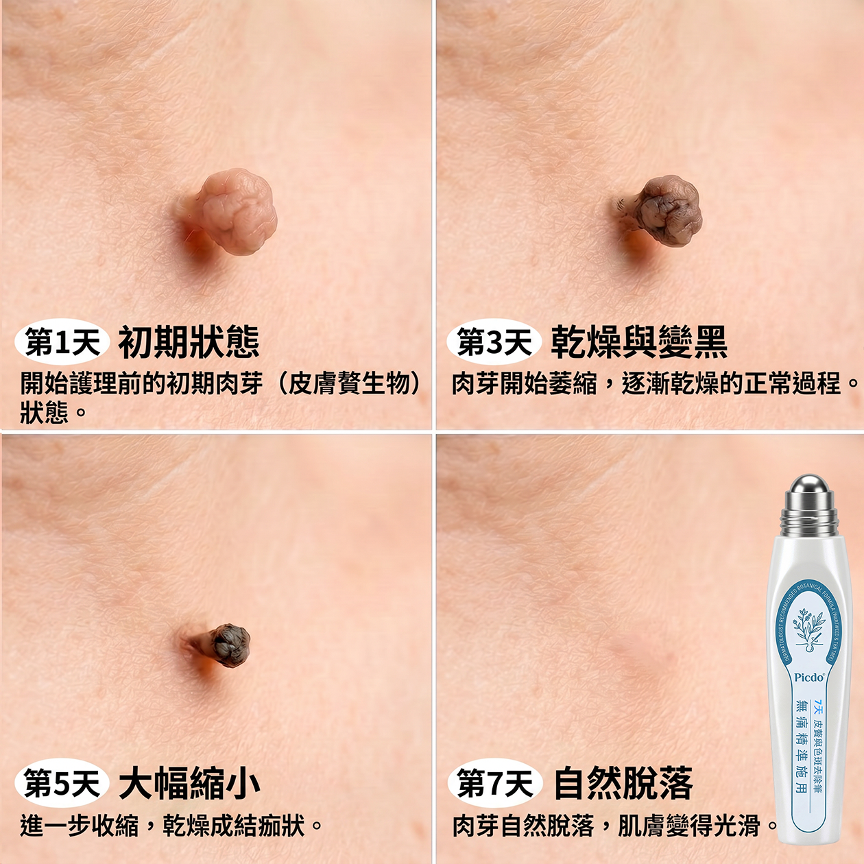 Picdo® 7天集中肌膚護理筆 精準滾珠設計｜輕鬆改善小肉芽與肌膚瑕疵 ✨
