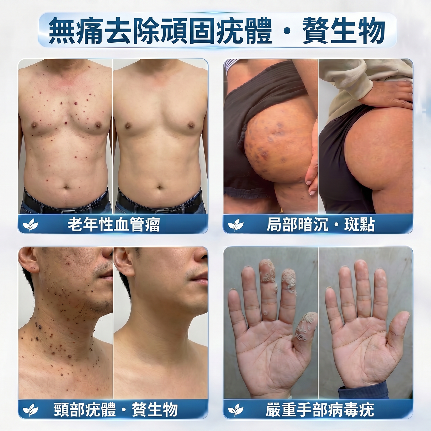 Picdo® 7天集中肌膚護理筆 精準滾珠設計｜輕鬆改善小肉芽與肌膚瑕疵 ✨
