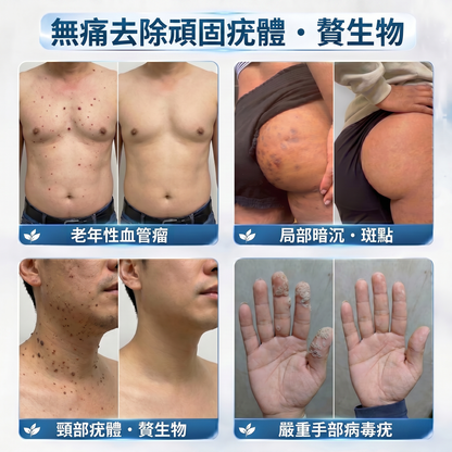 Picdo® 7天集中肌膚護理筆 精準滾珠設計｜輕鬆改善小肉芽與肌膚瑕疵 ✨